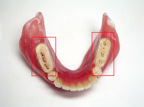 治療用義歯②