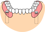部分入れ歯