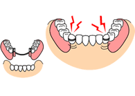 部分入れ歯