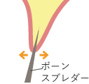 リッジエキスパンジョン