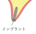 リッジエキスパンジョン